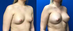 Breast Augmentation - Case 16
