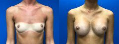Breast Augmentation - Case 4