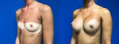Breast Augmentation - Case 4
