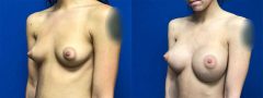 Breast Augmentation - Case 5