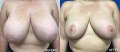 Breast Reduction - Case 1