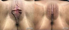 Labiaplasty - Case 1