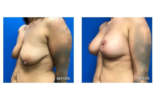 , Breast Lift W/ Augmentation