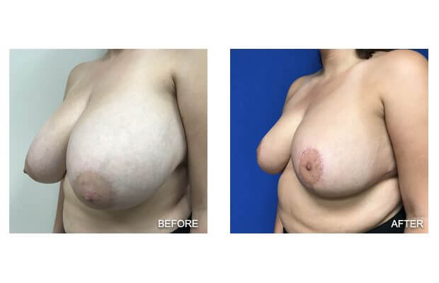 , Breast Reduction