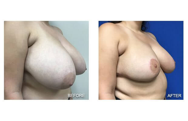 , Breast Procedure