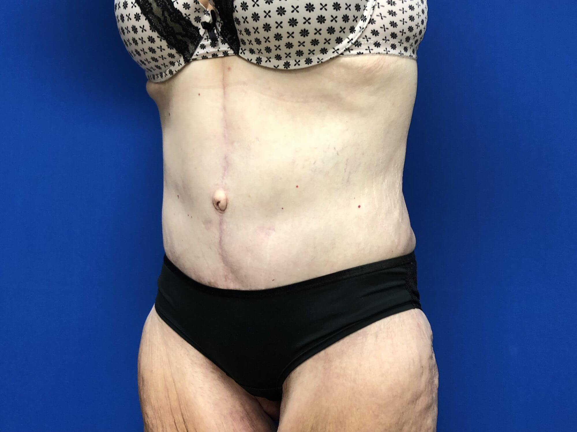Tummy Tuck Before & After Gallery Tampa - Bose Plastic Surgery