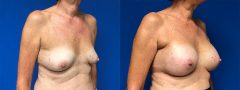 Breast Augmentation - Case 10