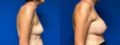 Breast Augmentation - Case 10