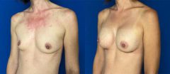 Breast Augmentation - Case 11