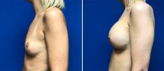 Breast Augmentation - Case 14