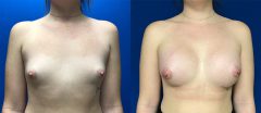 Breast Augmentation - Case 15