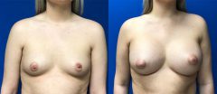 Breast Augmentation - Case 16