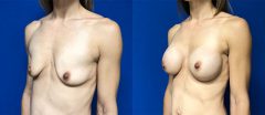 Breast Augmentation - Case 18