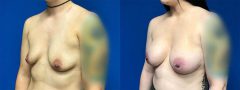 Breast Augmentation - Case 6