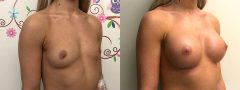 Breast Augmentation - Case 7