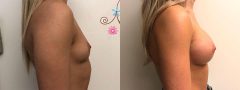 Breast Augmentation - Case 7