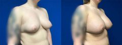 Breast Augmentation - Case 8