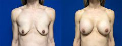 Breast Augmentation - Case 9
