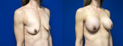 Breast Augmentation - Case 9