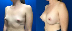 Breast Augmentation - Case 15