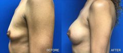 Breast Augmentation - Case 2