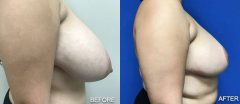 Breast Reduction - Case 1