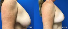 Breast Reduction - Case 2