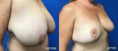Breast Reduction - Case 2