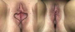 Labiaplasty - Case 9