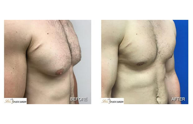 Nipple Surgery Tampa